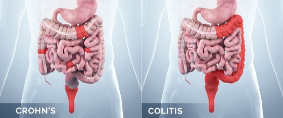 Rozdíl rozsahu poškození střev při ulcerózní kolitidě a Crohnově chorobě